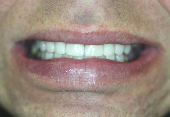 Восстановление режущего края центральных зубов