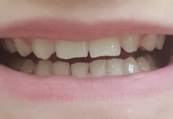 Реставрация зубов материалом Enamel Plus HRi