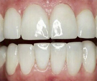 Проведена эстетическая реставрация зубов путем выполнения не прямых виниров