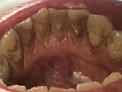 Профессиональная 5-ти этапная чистка зубов