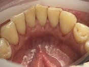 Профессиональная 5-ти этапная чистка зубов