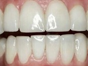 Проведена эстетическая реставрация зубов путем выполнения не прямых виниров