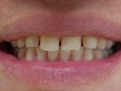 Реставрация центральных зубов материалом Enamel Plus HRi