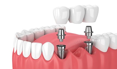 Зубной мост с опорой на имплантаты