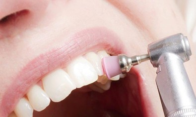 3. Полировка зубов