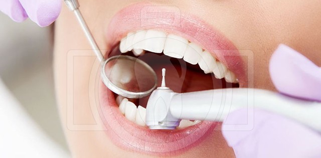 Пломбирование зубов, виды зубных пломб – полезные статьи и советы на ...