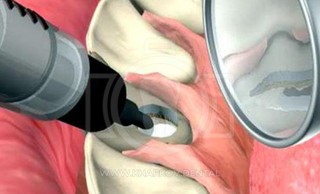 Белизна изнутри: внутриканальное отбеливание зубов или эндоотбеливание