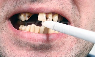 Как защитить зубы курильщика