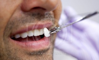 Люминиры на зубы: показания, преимущества, срок службы, стоимость