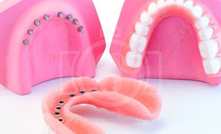 Мини-имплантация зубов