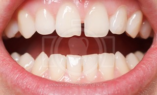 Промежутки между зубами: диастема, тремы