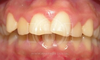 Зуб развернулся внутренней стороной к соседнему зубу при заболевании десен: что делать?