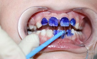 Серебрение молочных зубов Томск Ванцетти отзывы стоматология нежность томск