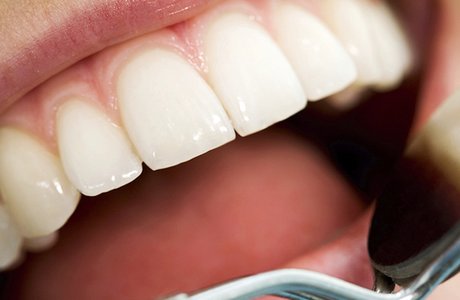 Причины разрушения эмалевого слоя. Методы восстановления эмали зубов