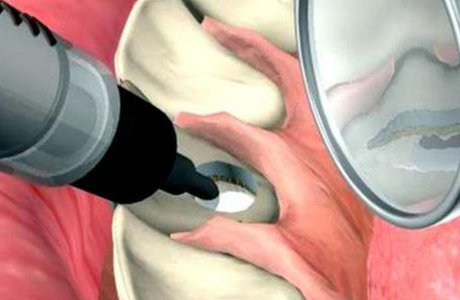 Белизна изнутри: внутриканальное отбеливание зубов или эндоотбеливание