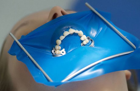 Коффердам – лечение зубов быстро, надежно, удобно