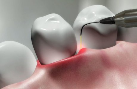 Лазерное лечение в стоматологии