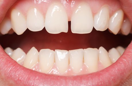 Промежутки между зубами: диастема, тремы