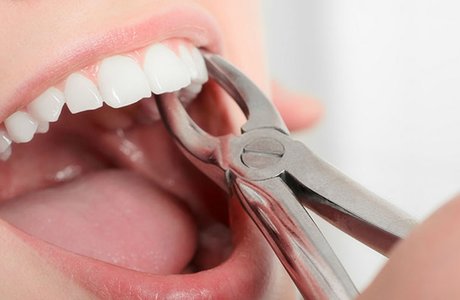 Удаление зуба: этапы, виды и стоимость
