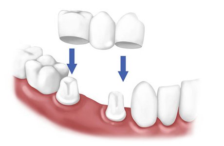 «Зубной мост» или что такое мостовидные зубные протезы?
