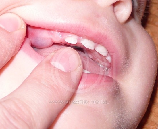 Что в стоматологии понимают под пульпитом?