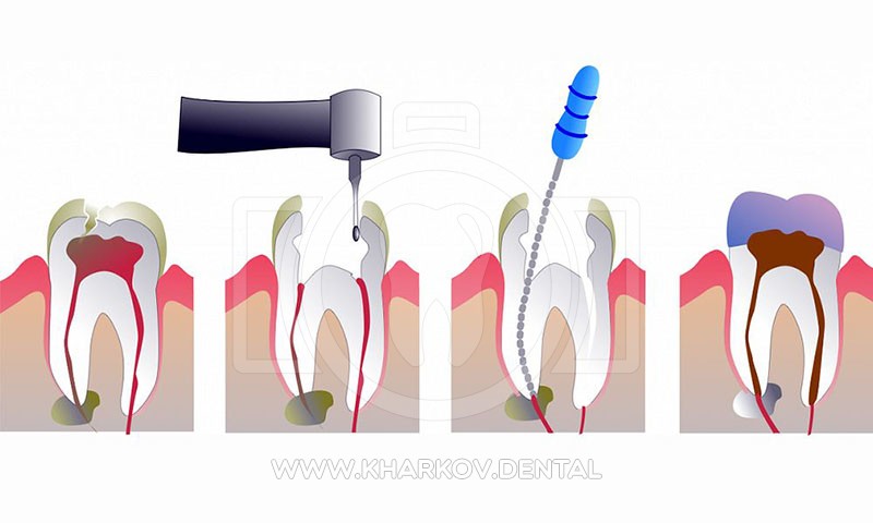 Лечение каналов зуба харьков
